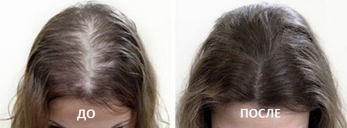 Лечение выпадения волос, облысения в Новосибирске